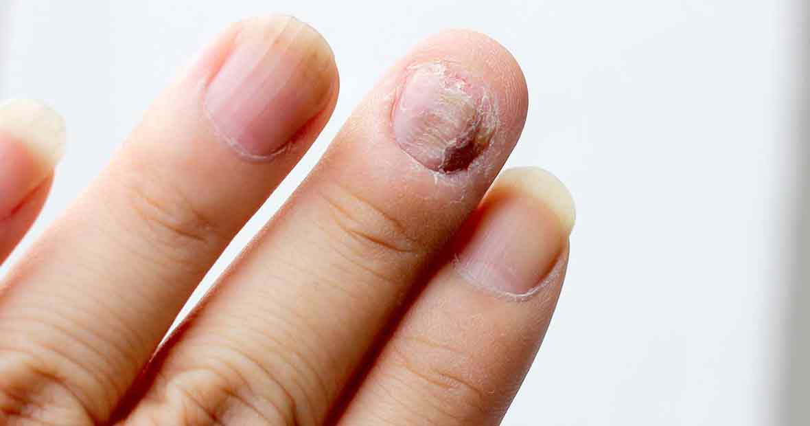mycoses des ongles